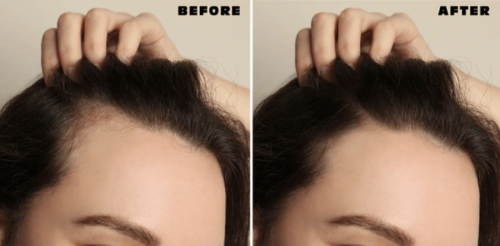 Before and after comparison of hair growth .