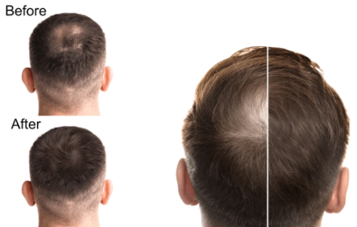Before and after comparison of hair growth,
